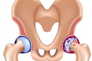 Stages of development of hip arthritis