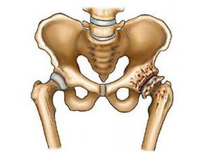 What is hip arthritis