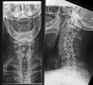 Cervical X-ray film-diagnosis method of osteochondrosis