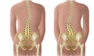 The development of scoliosis