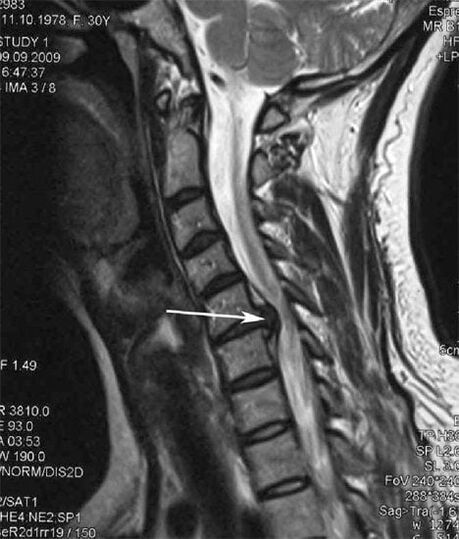 Spinal cord injury causes neck pain