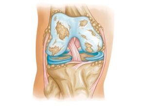 Damage to the knee joint by arthropathy