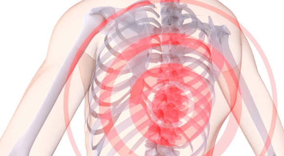 Spinal pain due to thoracic osteochondrosis